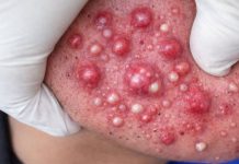 Cystic Acne Blackheads Extraction Whiteheads