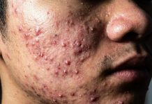 Cystic Acne Blackheads Extraction