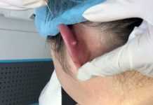 Blackheads Extraction