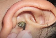 Blackheads Extraction Blackheads