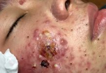 Cystic Acne Blackheads Extraction