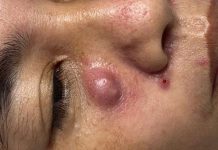 Big Cystic Acne Blackheads Extraction