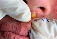 Blackheads Extraction Whiteheads