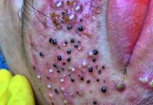 Acne Blackheads Extraction Blackheads