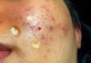 Cystic Acne Blackheads Whiteheads