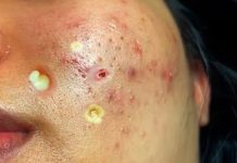 Cystic Acne Blackheads Whiteheads