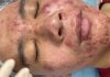 Cystic Acne Blackheads Extraction
