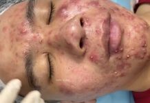 Cystic Acne Blackheads Extraction