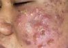 Cystic Acne Extraction Whiteheads