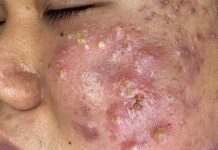Cystic Acne Extraction Whiteheads
