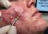 Cystic Acne Blackheads Extraction Whiteheads