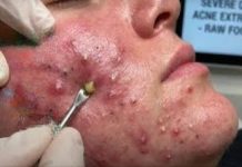 Cystic Acne Blackheads Extraction Whiteheads