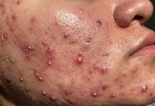 Cystic Acne Blackheads Extraction