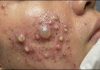 Cystic Acne Blackheads Extraction