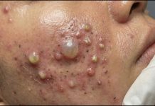 Cystic Acne Blackheads Extraction