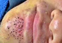 Cystic Blackheads Extraction