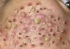 Acne Blackheads Extraction Whiteheads