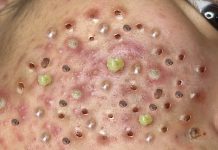 Acne Blackheads Extraction Whiteheads