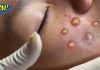 Acne Blackheads Extraction Whiteheads