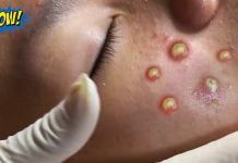 Acne Blackheads Extraction Whiteheads