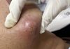 Blackheads Extraction