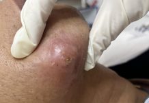 Blackheads Extraction