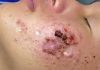 Big Cystic Acne Blackheads Extraction