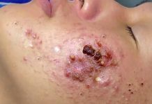 Big Cystic Acne Blackheads Extraction