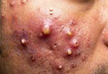 Big Cystic Blackheads Extraction Whiteheads