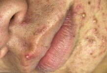 Acne Extraction Whiteheads