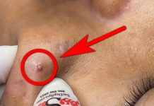 Acne Extraction Whiteheads