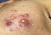 Cystic Acne Blackheads Extraction