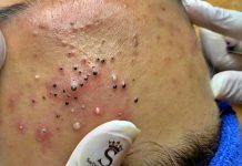 Cystic Blackheads Extraction