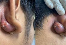 Big Cystic Blackheads Extraction