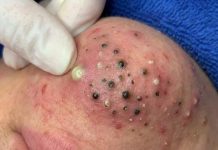 Cystic Acne Blackheads Extraction