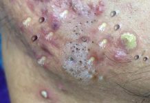 Acne Blackheads Extraction Whiteheads