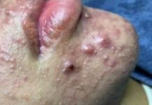 Cystic Acne Blackheads Extraction