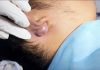 Big Cystic Blackheads Extraction