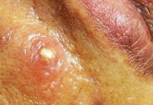 Cystic Extraction Whiteheads