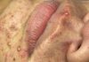 Blackheads Extraction Whiteheads
