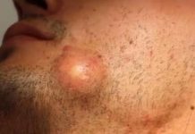 Big Cystic Blackheads Extraction