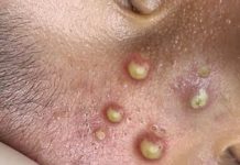 Acne Blackheads Whiteheads