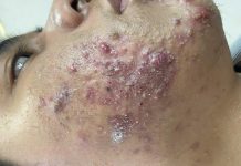 Cystic Acne Blackheads Extraction