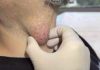 Big Cystic Blackheads Extraction