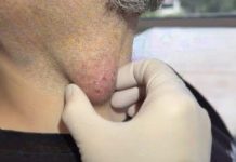 Big Cystic Blackheads Extraction