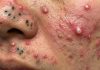 Acne Blackheads Extraction Whiteheads