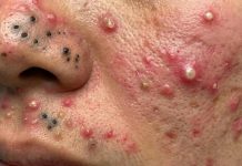 Acne Blackheads Extraction Whiteheads