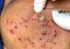 Big Cystic Acne Blackheads Extraction