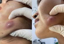 Big Cystic Acne Blackheads
