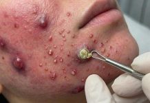 Big Cystic Acne Blackheads Extraction